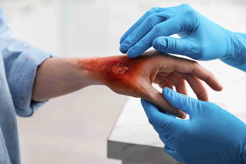 Patients' hand from burn injury treated by doctor.